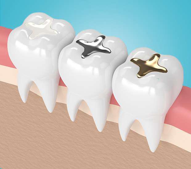 composite-dental-filling